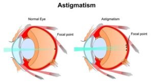 Normal vision vs astigmatism comparison with light focusing on retina