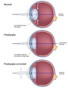 Presbyopia Causes, Symptoms & Treatment | Best Eye Clinic in Gurugram
