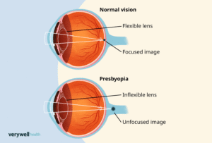 Presbyopia Causes, Symptoms & Treatment | Best Eye Clinic in Gurugram