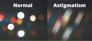 Myopia, Hyperopia, Astigmatism