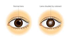 Cataract surgery |best eye care center in gurugram