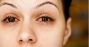 dry eye treatmnet