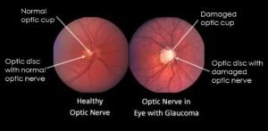 best eye center in gurugram
